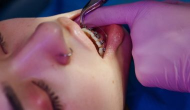 benefits to using invisalign