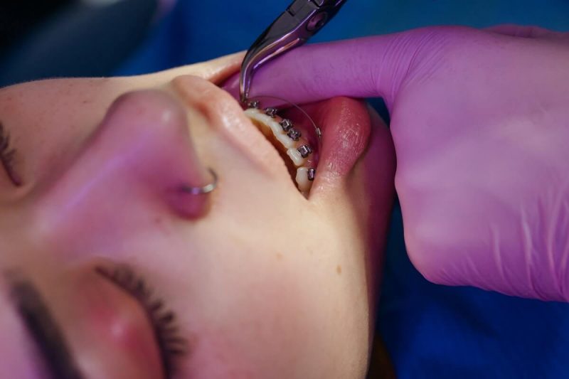 benefits to using invisalign