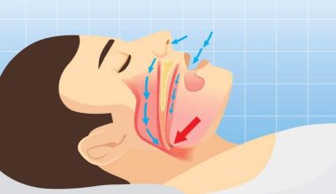 Sleep Apnea