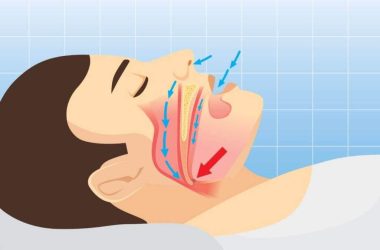 Sleep Apnea