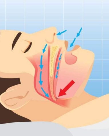 Sleep Apnea